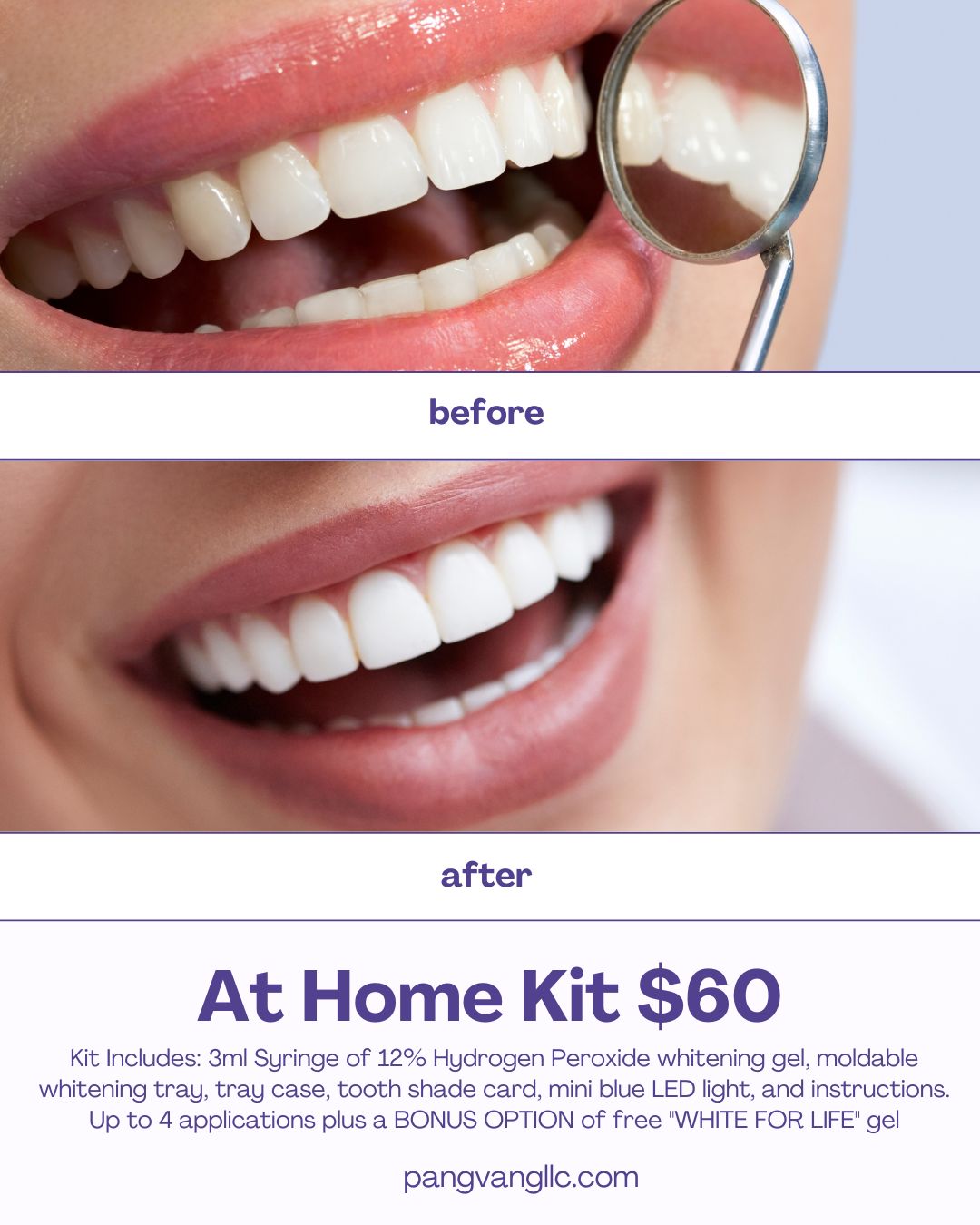 12% Premium Food Grade Hydrogen Peroxide Teeth Whitening Kit