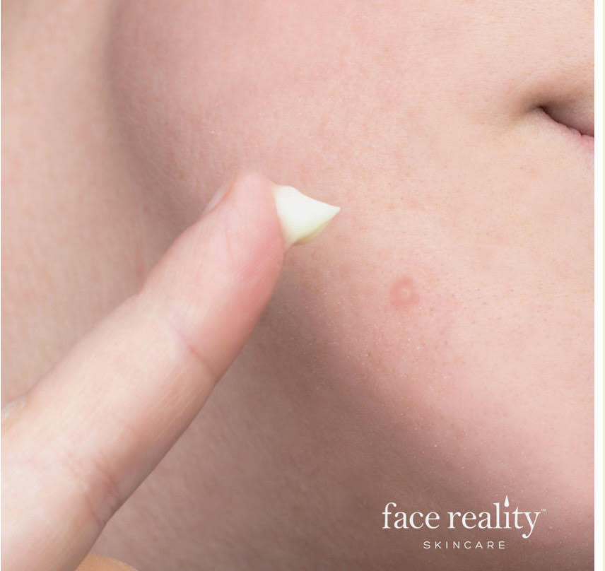 Acne: Face Reality Sulfur Spot Treatment