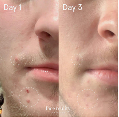 Acne: Face Reality Sulfur Spot Treatment